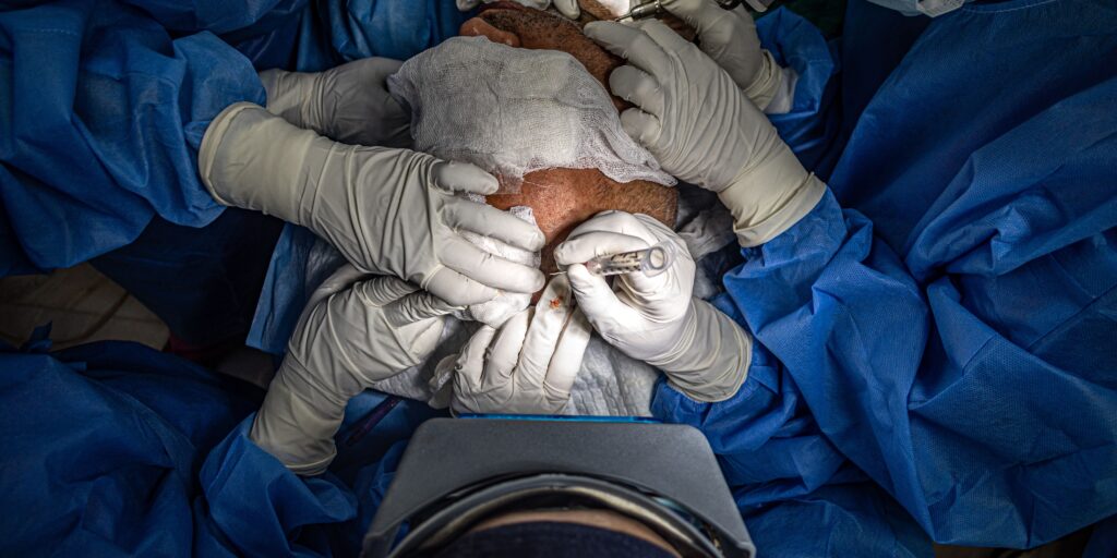 chirurgo che effettua trapianto capelli How Hair Transplants Work