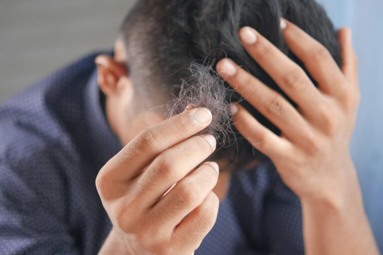 l'uomo ha perso i capelli a settembre