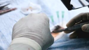 Trapianto di capelli prima e dopo mani di un chirurgo durante intervento