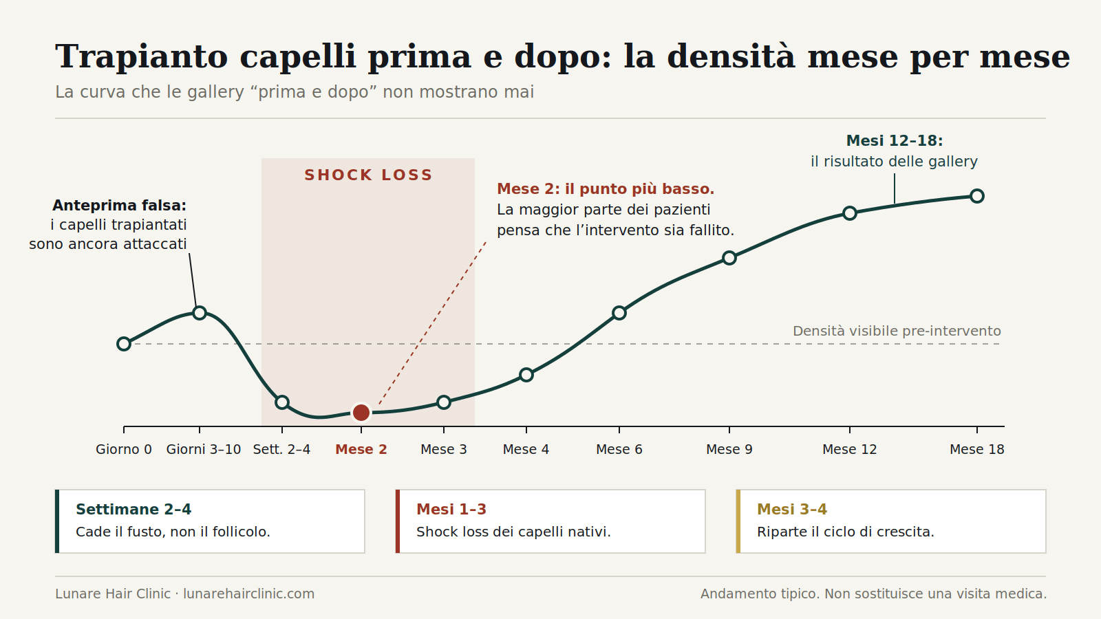 Tabella prima e dopo il trapianto di capelli: la densità diminuisce a causa della perdita da shock al 2° mese e aumenta fino al 18° mese