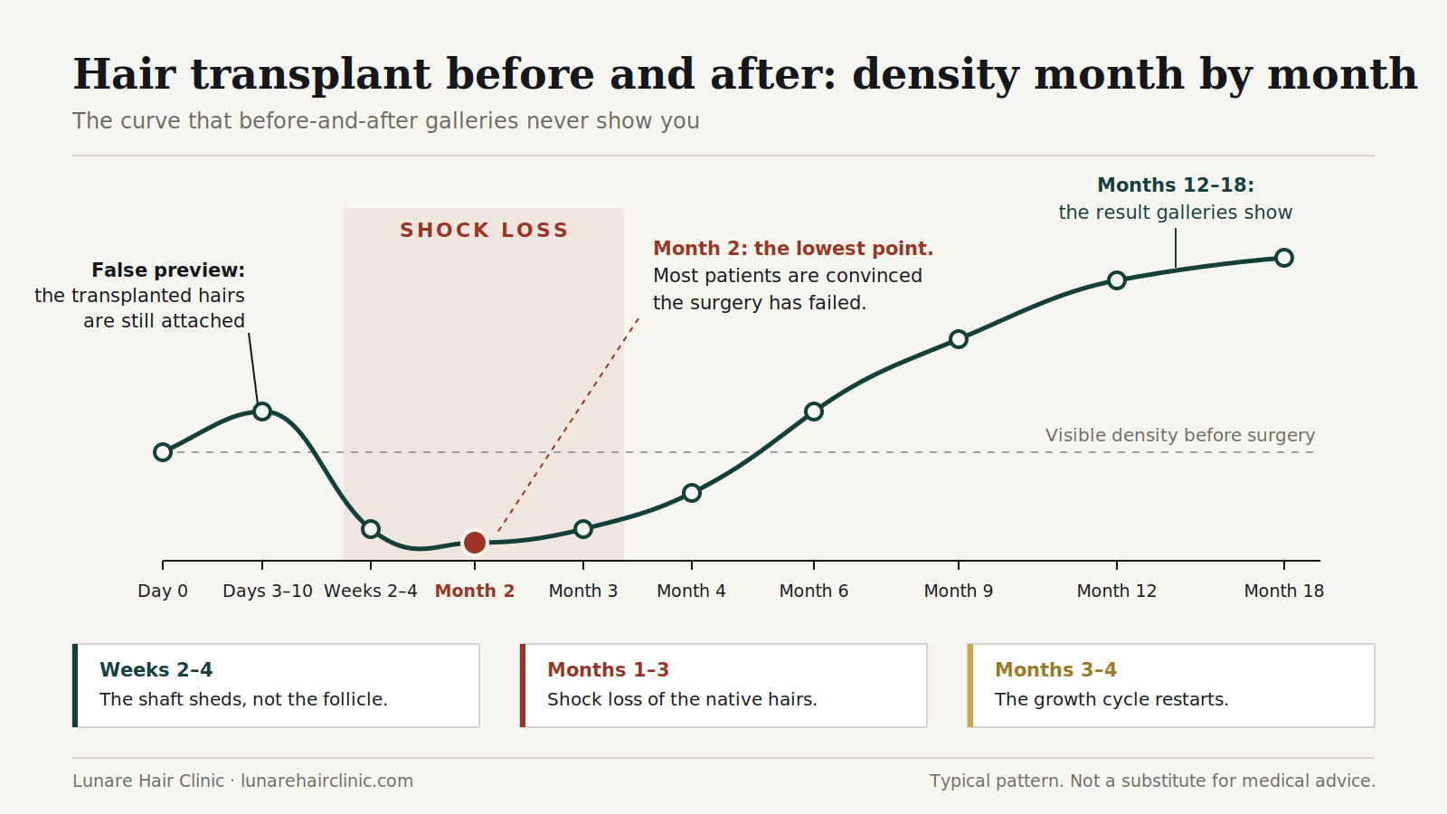 Hair transplant before and after chart: density drops with shock loss at month 2 and rises until month 18