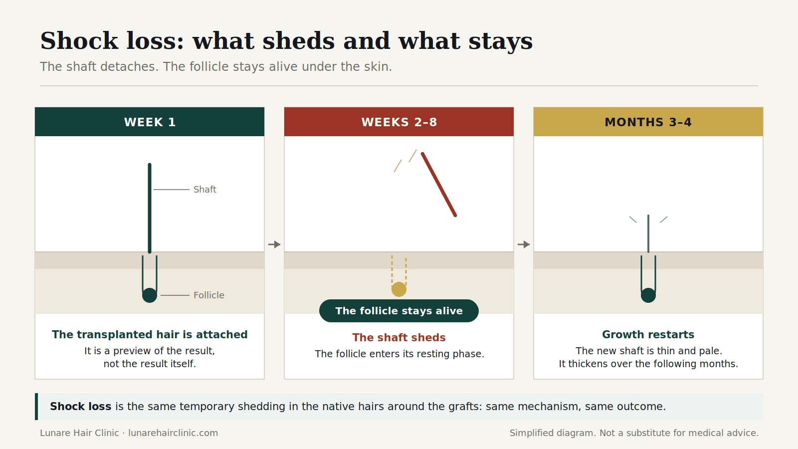 Shock loss after a hair transplant: the shaft sheds between weeks 2 and 8 while the follicle stays alive