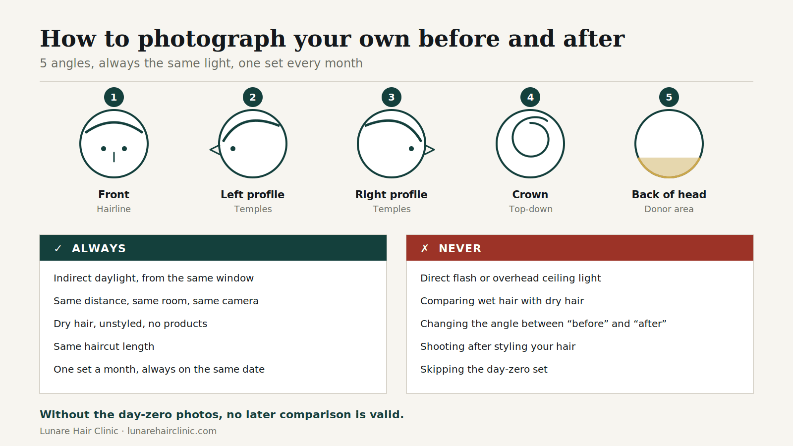 How to photograph hair transplant before and after: the 5 angles and lighting rules to repeat every month